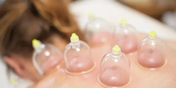 Woman's back getting cupping massage