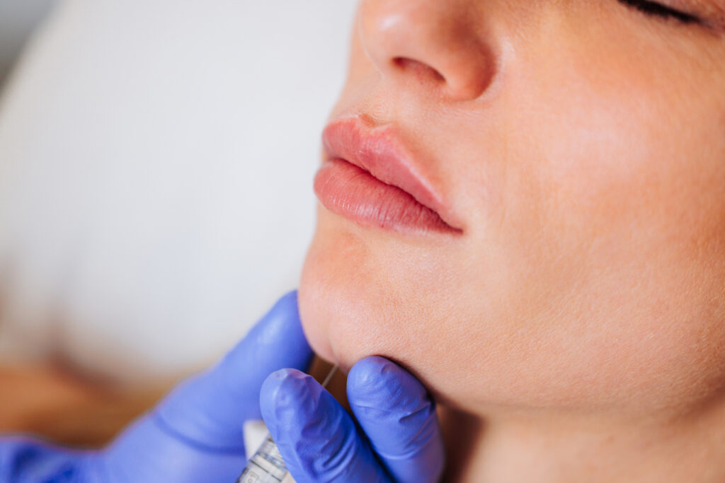 dermal filler injection in woman's chin